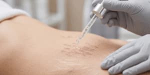 Trattamenti e Benefici dell’Acido Ialuronico per Smagliature