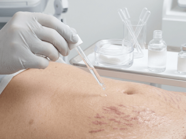 Applicazione acido ialuronico dopo peeling chimico