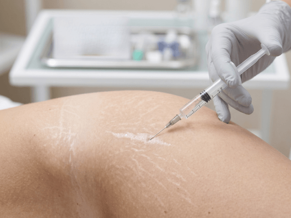 Iniezione filler acido ialuronico per riempimento smagliature