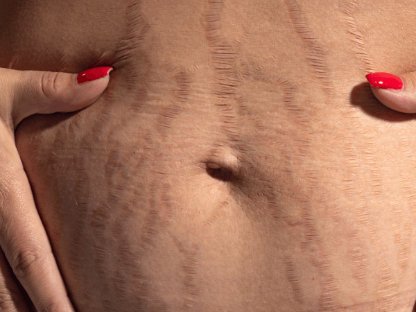 Dettaglio smagliature rosse in fase infiammatoria
